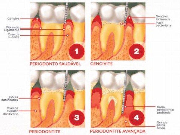 periodontite