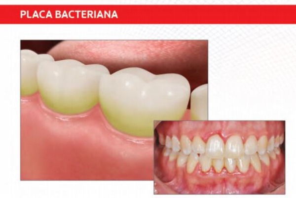 Placa bacteriana
