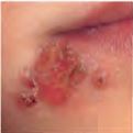 herpes