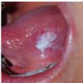 leucoplasias